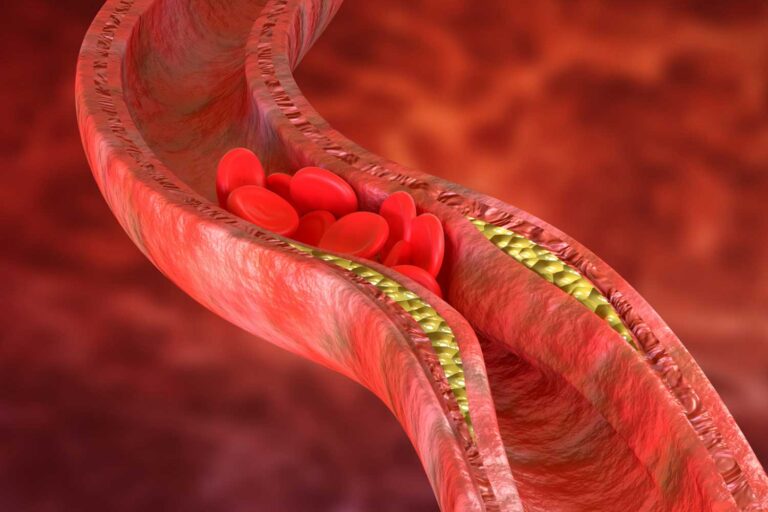 Računalniška grafika prikazuje prerez žile z aterosklerotičnim plakom in ozkim prehodom za rdeče krvničke